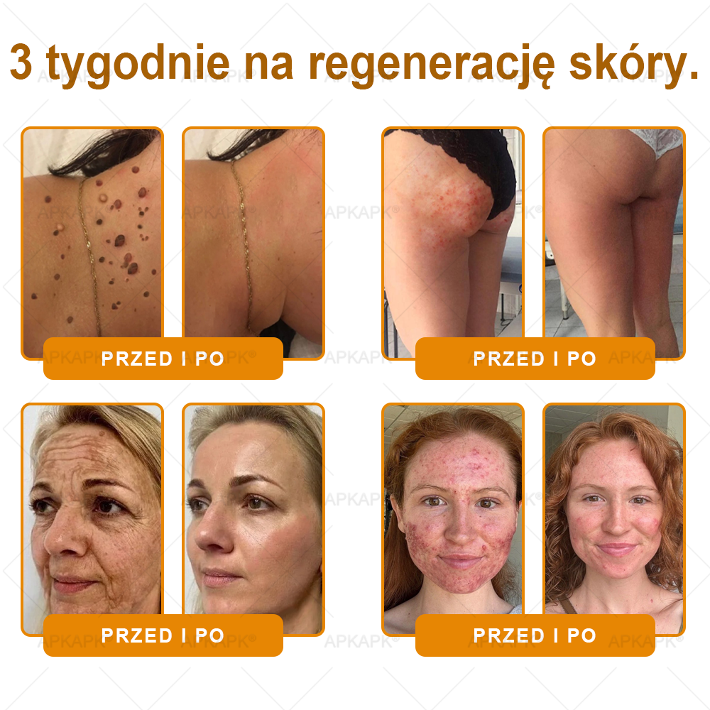 ✨ΑPΚΑPK® Jad Pszczoły Kompleksowy Krem✨pomaga w leczeniu problemów skórnych, takich jak: zmarszczki, blizny, plamy pigmentacyjne, rozstępy, trądzik, łuszczyca, egzema, zmiany skórne, podrażnienia, stany zapalne i inne problemy skórne🫏