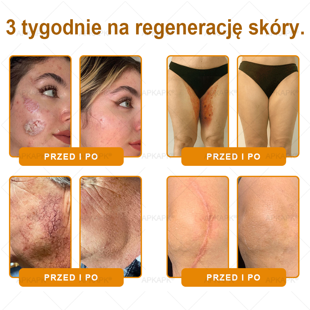 ✨ΑPΚΑPK® Jad Pszczoły Kompleksowy Krem✨pomaga w leczeniu problemów skórnych, takich jak: zmarszczki, blizny, plamy pigmentacyjne, rozstępy, trądzik, łuszczyca, egzema, zmiany skórne, podrażnienia, stany zapalne i inne problemy skórne🫏