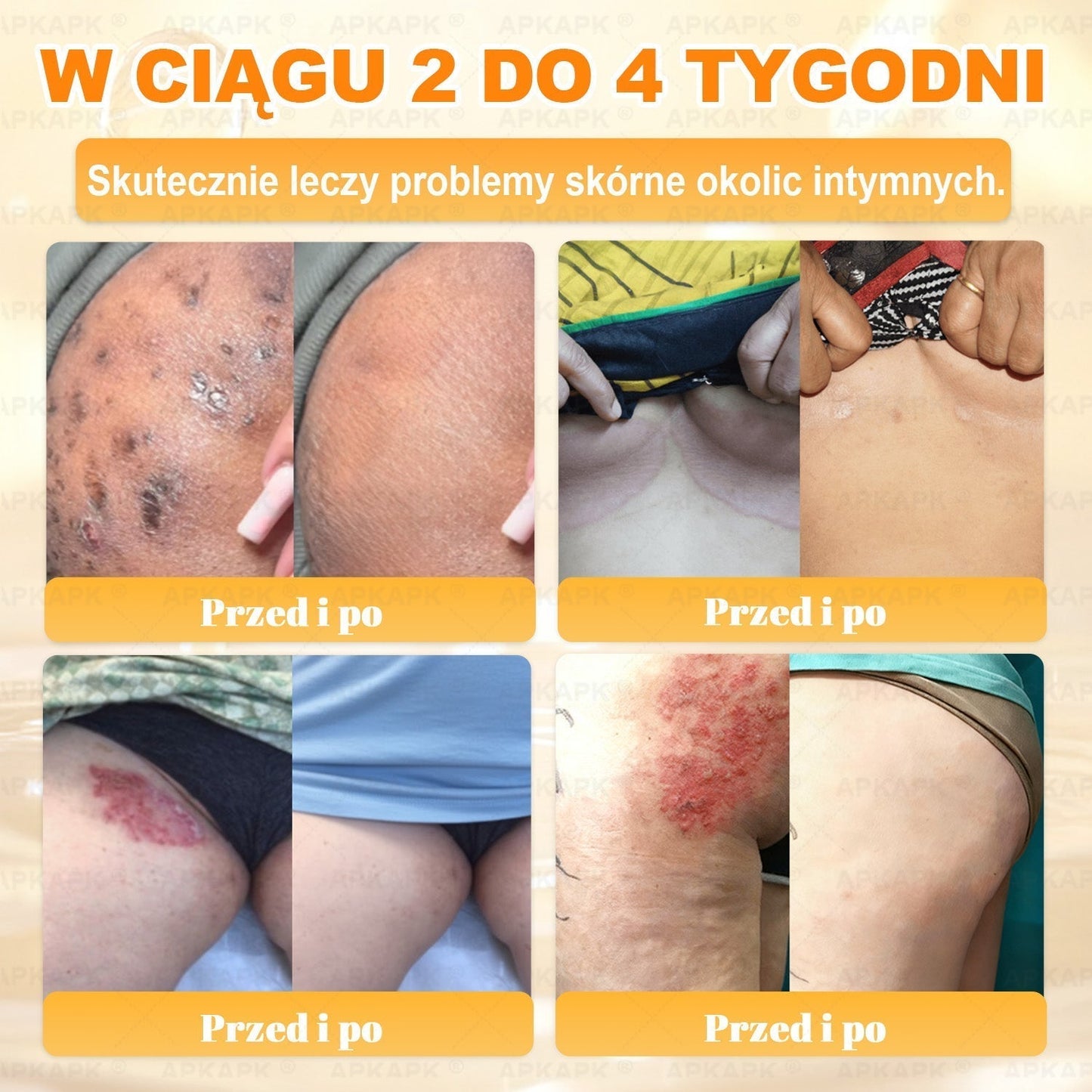 ✨ΑPΚΑPK® Jad Pszczoły Kompleksowy Krem✨pomaga w leczeniu problemów skórnych, takich jak: zmarszczki, blizny, plamy pigmentacyjne, rozstępy, trądzik, łuszczyca, egzema, zmiany skórne, podrażnienia, stany zapalne i inne problemy skórne🫏