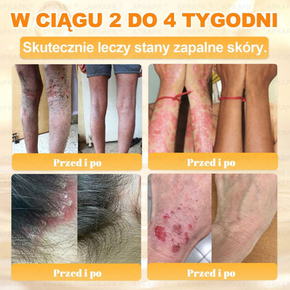✨ΑPΚΑPK® Jad Pszczoły Kompleksowy Krem✨pomaga w leczeniu problemów skórnych, takich jak: zmarszczki, blizny, plamy pigmentacyjne, rozstępy, trądzik, łuszczyca, egzema, zmiany skórne, podrażnienia, stany zapalne i inne problemy skórne🫏